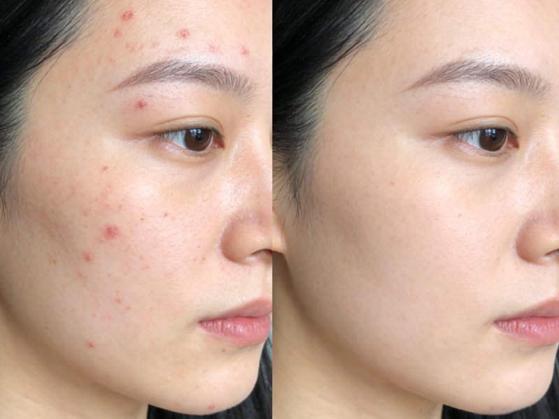 針清暗瘡正確手法｜不紅腫、不反彈、不留印｜美容初學必學 #7