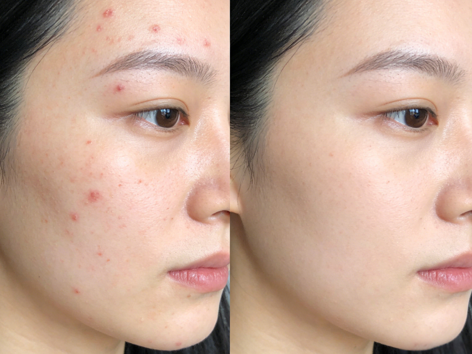 針清前準備：消毒工具與皮膚清潔示意圖