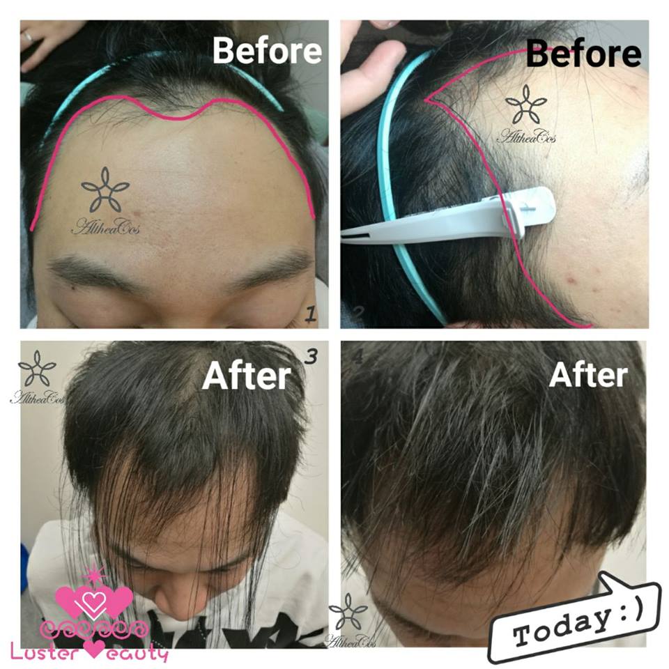 AltheaCos Japan Japanese Korea 日式增髮 韓式增髮 日韓半永久增髮填充術 Korean Style Special Hair Extension Skills Lawrance 1